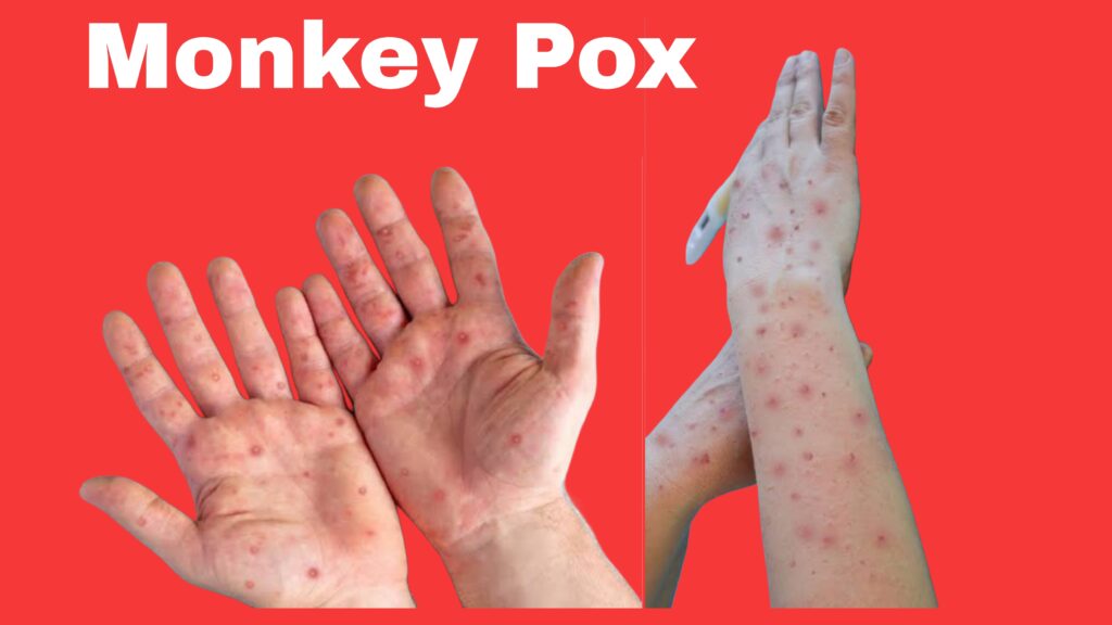 Monkey pox